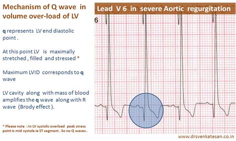 lv volume overload|is lvh life threatening.